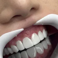 کامپوزیت دندان ، اصلاح طرح لبخند ، لمینت|خدمات آرایشگری و زیبایی|تهران, نظامی گنجوی (توانیر)|دیوار