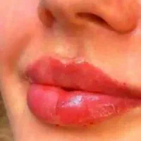 آف سه روزه کلیه خدمات ژل وبوتاکس وزیبایی