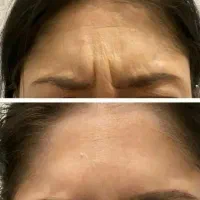 ژل و بوتاکس وهایفو