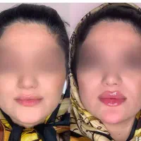 تزریق ژل لب و بوتاکس و گونه چونه و مزو و پی آر پی