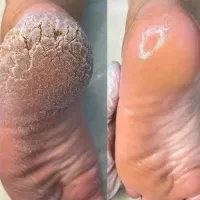 پدیکور پا حرفه ای