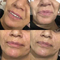 ژل بوتاکس پیرسینگ مزوژل آنزیم آموزش|خدمات آرایشگری و زیبایی|اسلام‌‌آباد غرب, |دیوار