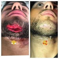 لیفت شقیقه،جای زخم(اسکار) بلفاروبوتاکس فیلر|خدمات آرایشگری و زیبایی|اهواز, زیتون کارگری|دیوار