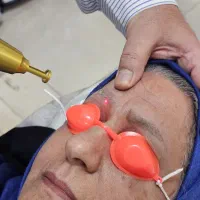 پاک کردن تتو ابرو و بدن (دکتر علی بابایی)