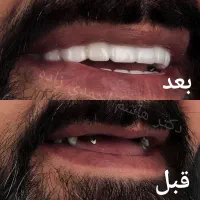ایمپلنت دندان کاشت و روکش فوری اوردنچر از دم اقساط|خدمات آرایشگری و زیبایی|تهران, قیطریه|دیوار