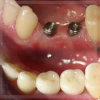 شرایط ویژه جشنواره دندانپزشکی ایمپلنت اوردنچر روکش|خدمات آرایشگری و زیبایی|تبریز, |دیوار