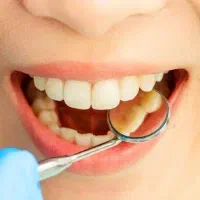 عصب کشی دندان