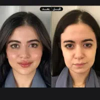 ژل..بوتاکس ..فول فیس و کلیه خدمات زیبایی