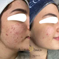 رفع تخصصی جای جوش|خدمات آرایشگری و زیبایی|تهران, قبا|دیوار