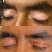 درمان تضمینی پیسی و پسوریازیس|خدمات آرایشگری و زیبایی|مشگین شهر, |دیوار