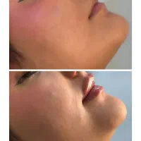 تخفیف ویژه و اقساطی تزریق ژل لب،فیلر،فول فیس،مزوژل