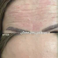 لیزر بوتاکس پی ارپی توسط دکتر|خدمات آرایشگری و زیبایی|مشهد, وکیلآباد|دیوار