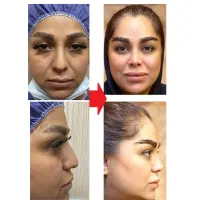 عمل جراحی بینی بامتخصص گوش،حلق،بینی|خدمات آرایشگری و زیبایی|تهران, یوسف‌آباد|دیوار