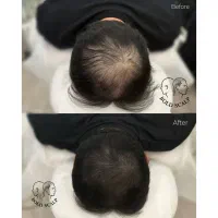 میکرواسکالپ،مزونیدلینگ،مکمل کاشت مو،اسکراب اسکالپ