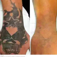 پاک کردن تتو کربن پیل و درمان لک با لیزر کیوسوییچ