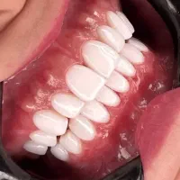 کامپوزیت دندان ۵۰٪ تخفیف اقساط|خدمات زیبایی و سلامت|کرج, عظیمیه|دیوار