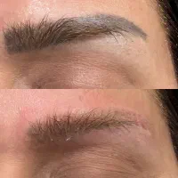 پاک کردن تتو صورت وبدن لیزر کیوسوئیچ|خدمات زیبایی و سلامت|تهران, آهنگ|دیوار