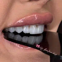 کامپوزیت دندان سارمکو کاریزما ای پی اس|خدمات زیبایی و سلامت|تهران, نارمک جنوبی|دیوار