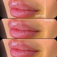 ژل و بوتاکس|خدمات آرایشگری و زیبایی|تهران, تهرانسر شمالی|دیوار