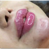 تزریق ژل و بوتاکس مزوتراپی