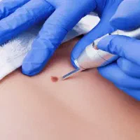 میکرو اسکالپ موی سر ،ریش، ابرو( در محل)|خدمات آرایشگری و زیبایی|تهران, سعادتآباد|دیوار