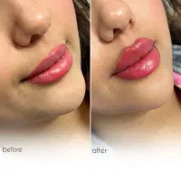 کلینیک زیبایی ژل لب روسی فیلر زاویه مزوبوتاکس لیزر|خدمات آرایشگری و زیبایی|شهریار, شهریار|دیوار