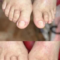 خارج کردن ناخن از داخل گوشت  و نصب ارتونیل|خدمات آرایشگری و زیبایی|مشهد, شهرک امام هادی (شهرک غرب)|دیوار