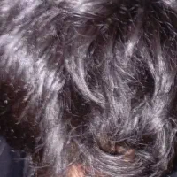 رفع شوره سر