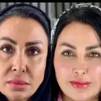 ژل و بوتاکس ۷۵۰ .مید فیس ۴۵۰۰ توسط پزشک مجرب