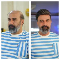 بزرگ ترین مرکز پروتز مو و تعمیر ضمانت داردراصفهان