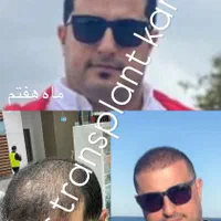 کاشت مو ابرو ریش|خدمات آرایشگری و زیبایی|تهران, جماران (نیاوران)|دیوار