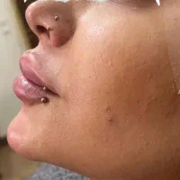 جشنواره تزریق ژل و فیلر و بوتاکس فقط هزینه مواد