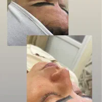 فیشیال تخصصی پوست + تخفیف ویژه