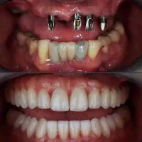 ایمپلنت یک روزه دیجیتال بدون درد با اقساط دوساله