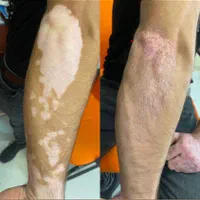 درمان گیاهی بیماری پیسی وپسوریازیس|خدمات آرایشگری و زیبایی|مشهد, حرم مطهر رضوی|دیوار