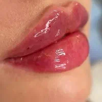 ژل لب، فیلر صورت، بوتاکس