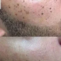 پاک کردن تاتوهای قدیمی وجدید مثل حیوانات ونوشتاری|خدمات آرایشگری و زیبایی|قم, بلوار امین و ساحلی|دیوار