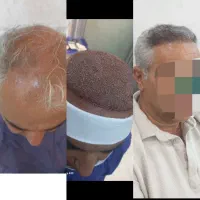 کاشت مو ابرو