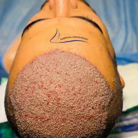 کاشت مو شیراز ارومیه