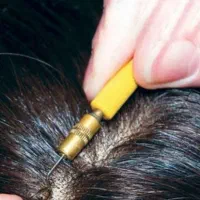 ترمیم پروتز