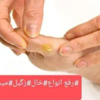 برداشت خال زگیل میخچه ختنه در مطب|خدمات آرایشگری و زیبایی|قم, هفت تیر|دیوار