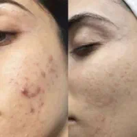 تکنیک پوست مار یا الگاپیل، اسپیکول تراپی|خدمات آرایشگری و زیبایی|شیراز, فضل‌آباد|دیوار