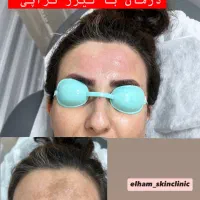 کلینیک لیزرموهای زائدالکساندرایت پلاس شاتی(هوشمند)|خدمات آرایشگری و زیبایی|رشت, گلسار|دیوار
