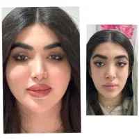 پاکسازی و آل ای دی تراپی رایگان در مطب پزشک