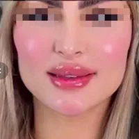 تزریق چربی ،ساکشن غبغب،پی ارپی مو ،مزو زگیل میخچه