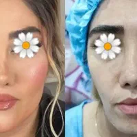 تزریق چربی به صورت تضمینی ماندگاری دائم