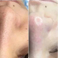 مدل رایگان فیشیال و پاکسازی پوست