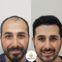 کاشت مو ۲۲ و کاشت ابرو ۱۵