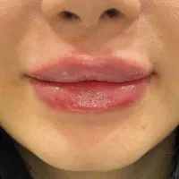 آموزش کامل و تزریق فیلر بوتاکس مزو آنزیم