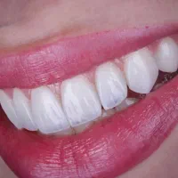 کامپوزیت،لمینت،روکشطلا،اقساطی|خدمات زیبایی و سلامت|تهران, جردن|دیوار